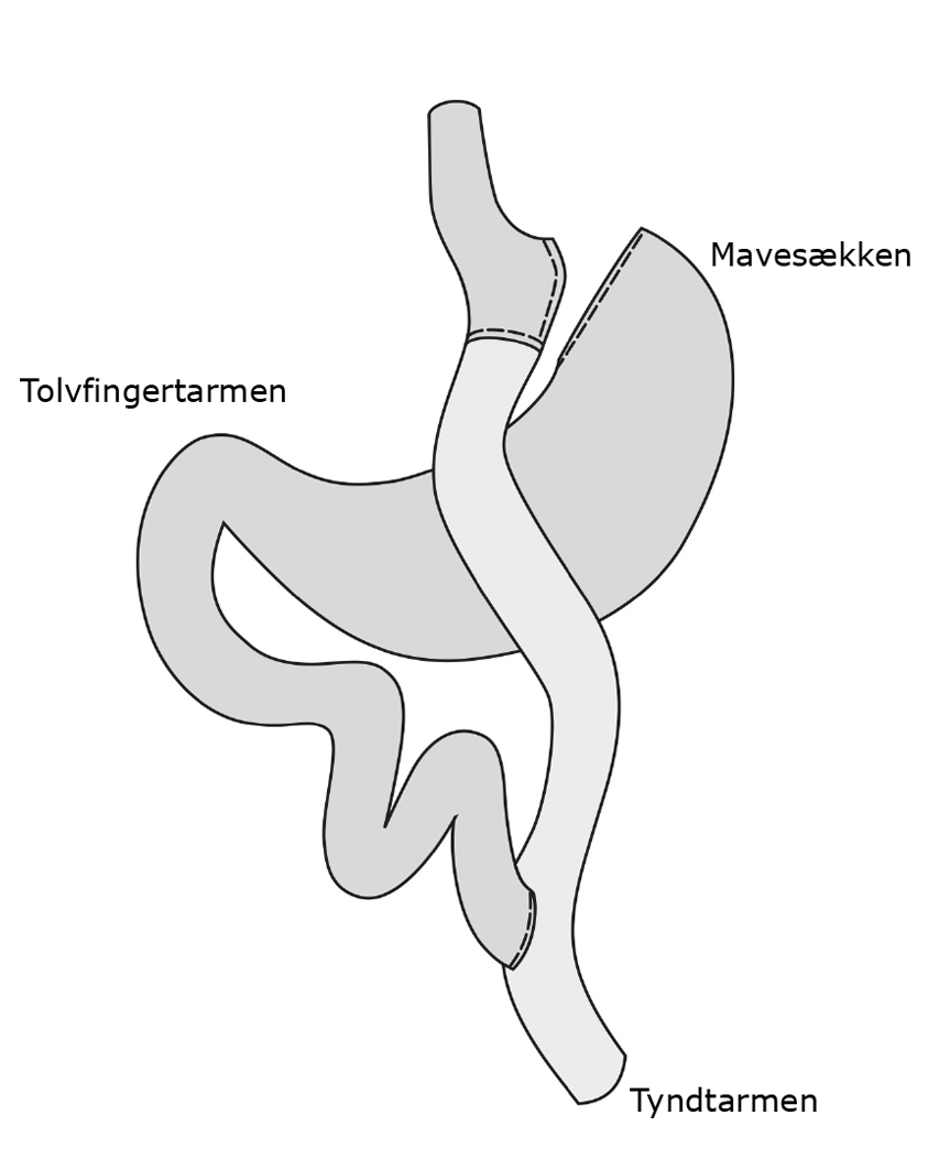 Tegning af mave/tarmforløbet efter en Gastric Bypass operation