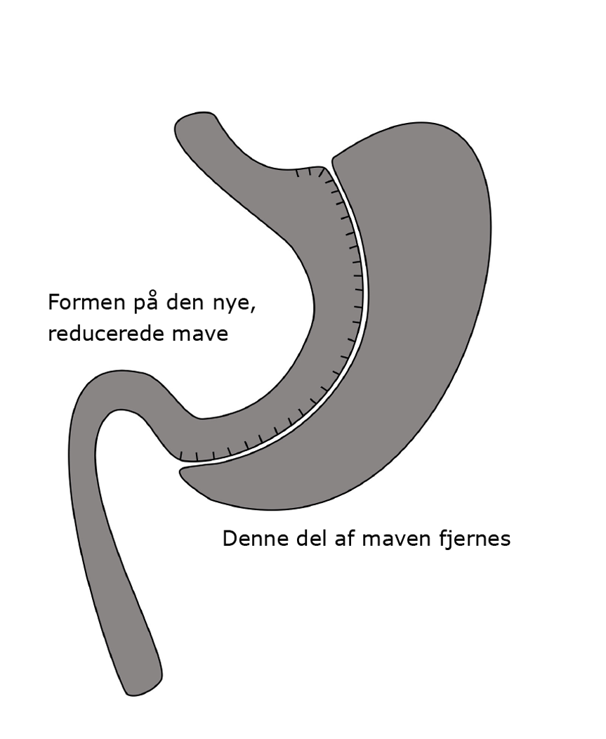 Tegning af mave/tarmforlÃ¸bet efter en Gastric Sypass operation