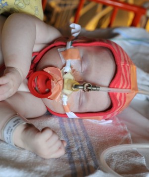 Billede af spædbarn med CPAP