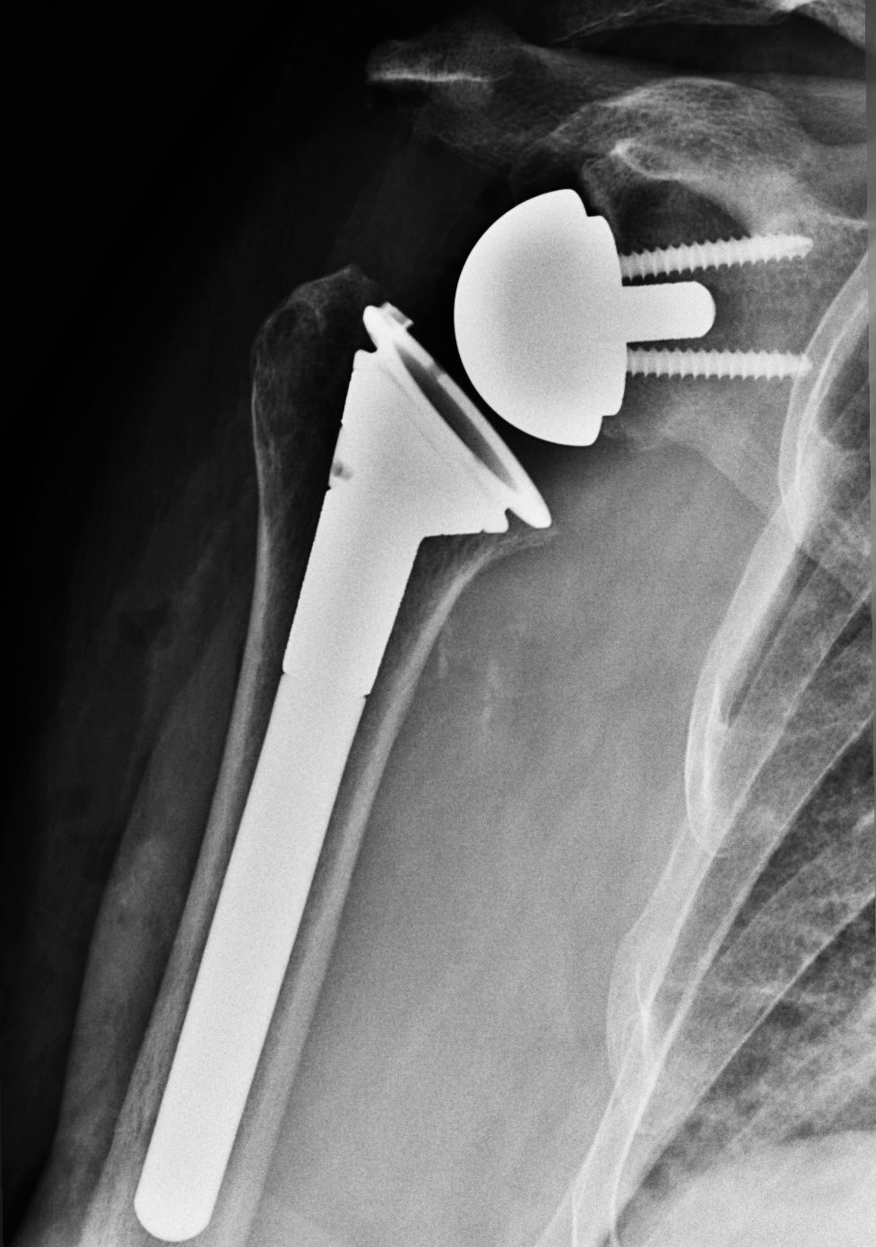 Røntgen billede af skulder, hvor der er isat en omvendt skulderprotese