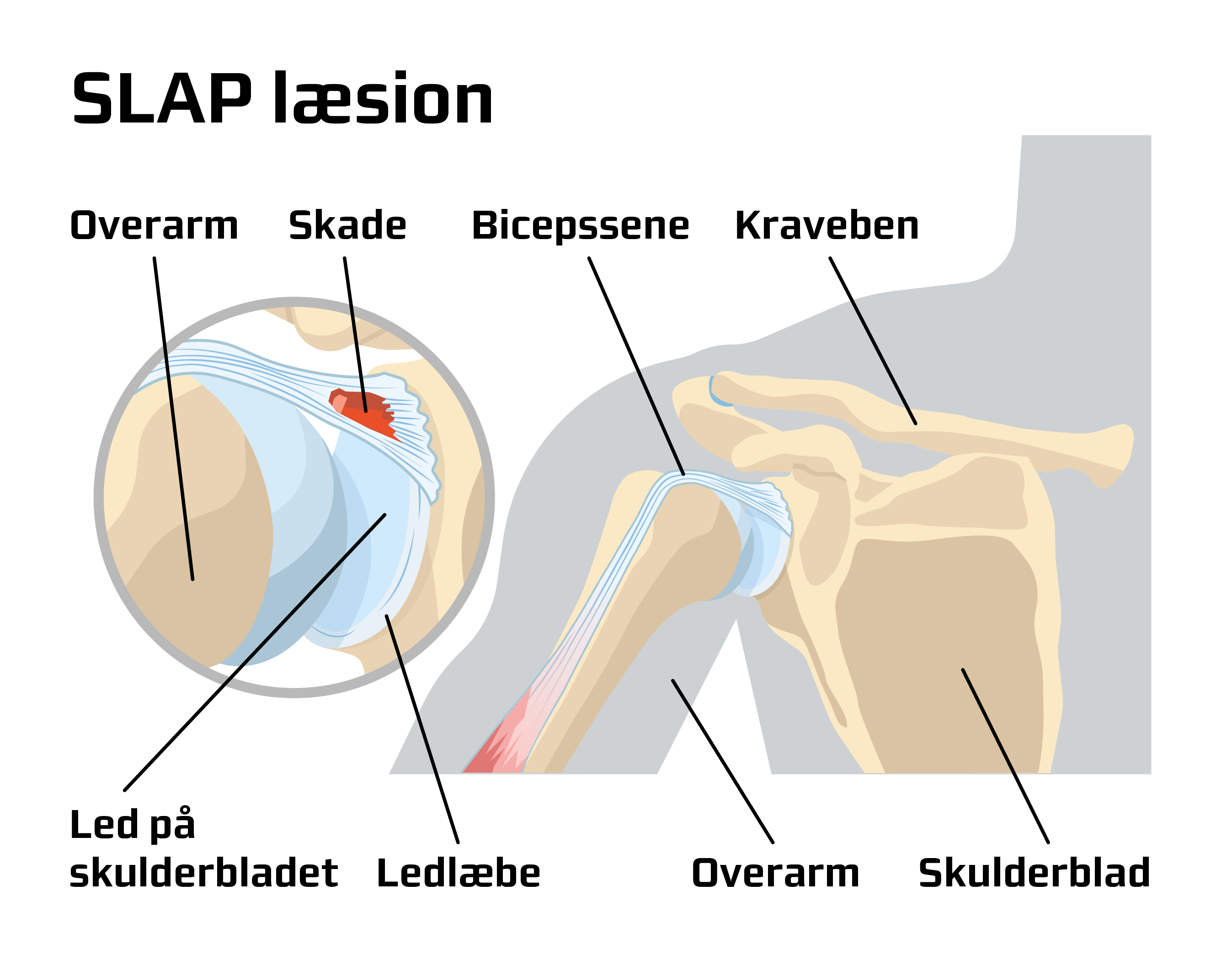 SLAP_9689_Ledlæbeskade på bicepssenens tilhæftning.png