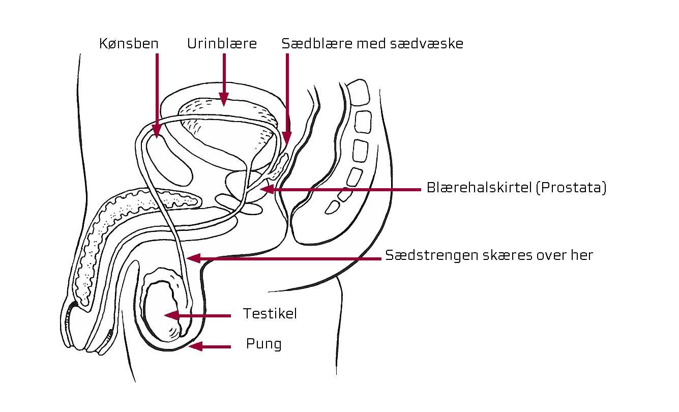 Sterilisation af mænd i lokalbedøvelse | Regionshospitalet Silkeborg - Midt