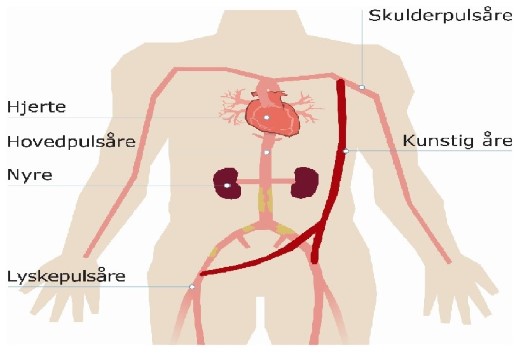 Illustrationen af en bypass til begge lysker