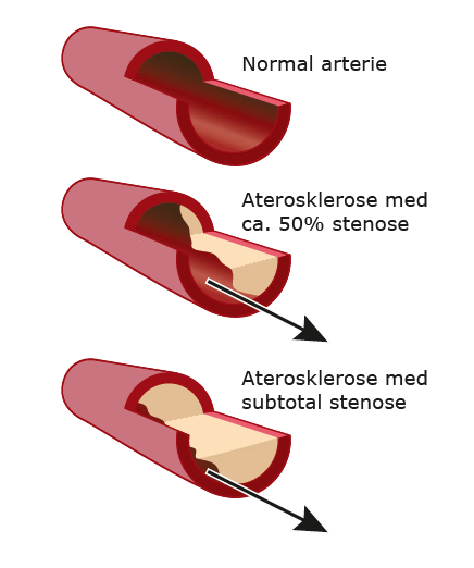 Hvordan ser åreforkalkning ud 2 centrale.png