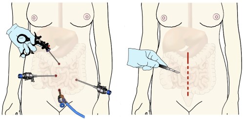 Illustrationen viser hvordan henholdsvis en kikkertoperation og en åben operation kan se ud.