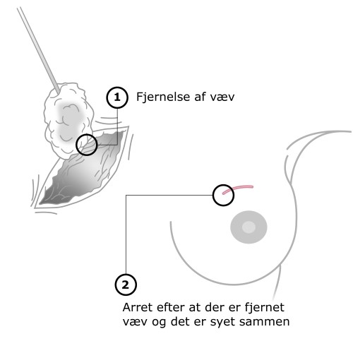 Fjernelse af væv og ar efter operation