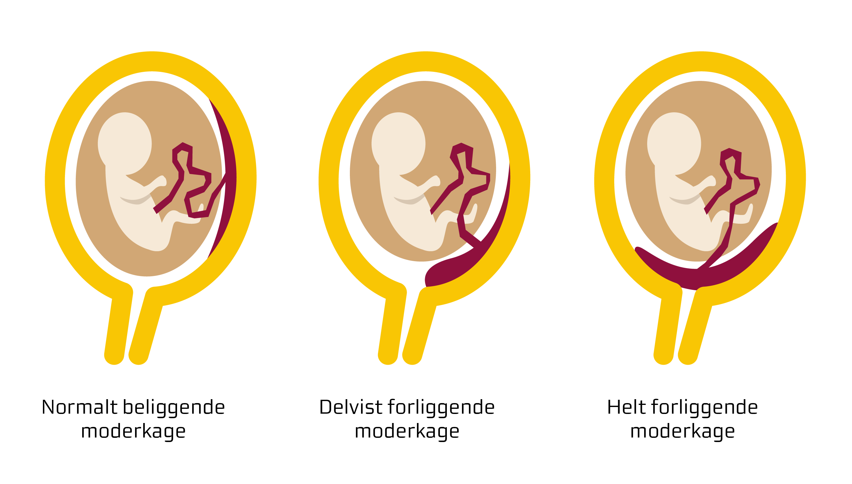 Forskellen mellem en normalt liggende, delvist forliggende og helt forliggende moderkage