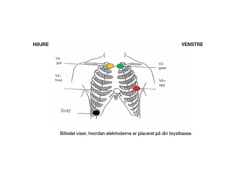 Elektrodernes placering - Holtermonitorering.jpg
