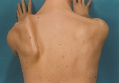 Englevinge (Scapula Alata) - nr 1+3.jpg