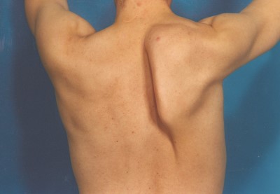 Englevinge (Scapula Alata) - nr 2.jpg