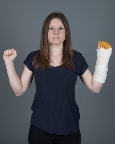 Håndledsbrud behandlet med gips 1.jpg