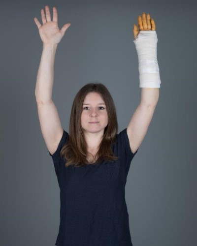 Håndledsbrud behandlet med gips 2.jpg