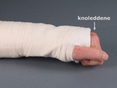 Håndledsbrud behandlet med gips 3.jpg