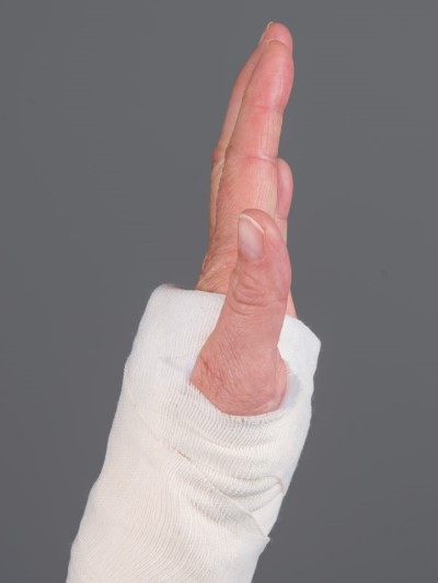 Håndledsbrud behandlet med gips 4.jpg