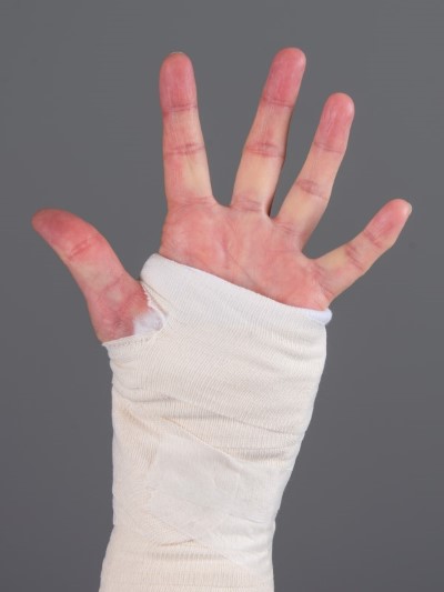 Håndledsbrud behandlet med gips 5.jpg