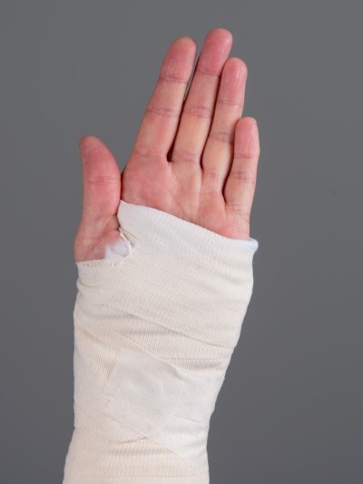 Håndledsbrud behandlet med gips 6.jpg