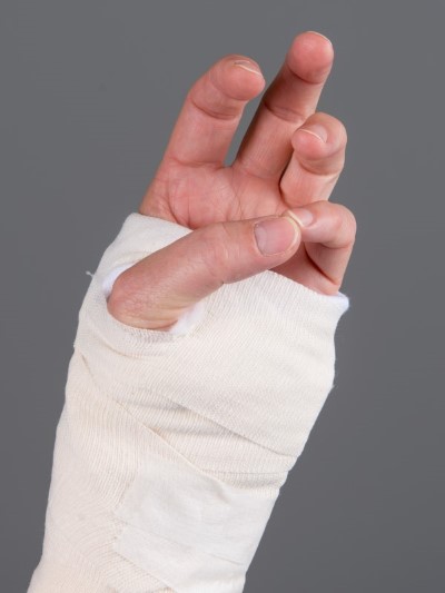 Håndledsbrud behandlet med gips 7.jpg