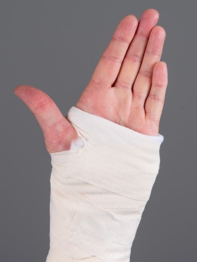 Håndledsbrud behandlet med gips 9.jpg